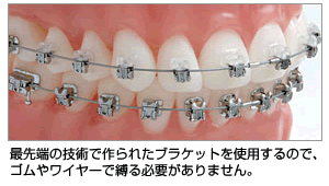 矯正歯科｜デーモンシステム
