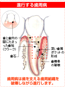 進行する歯周病