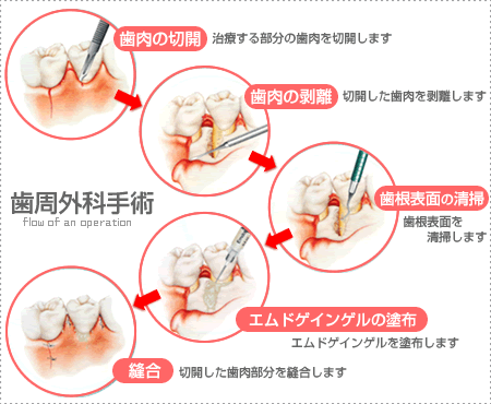 歯周外科手術の流れ